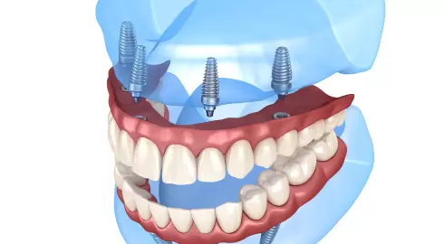 Ağızda hiç diş yoksa implant yapılır mı?